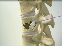 Нижегородские ученые создали костный цемент, превосходящий американский аналог